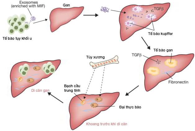 5 loại ung thư gan
