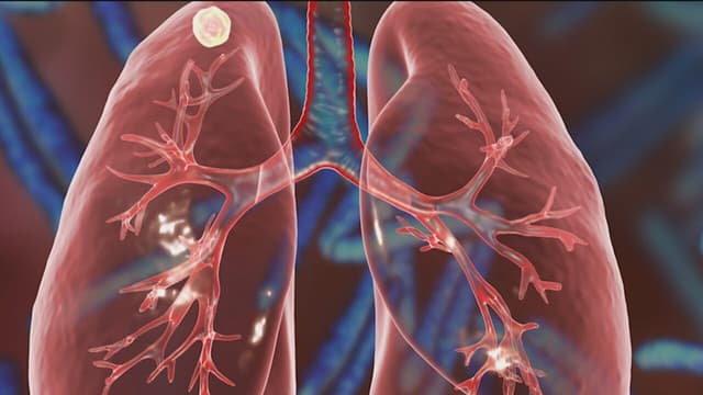 Tìm hiểu cách điều trị ung thư phổi giai đoạn 1