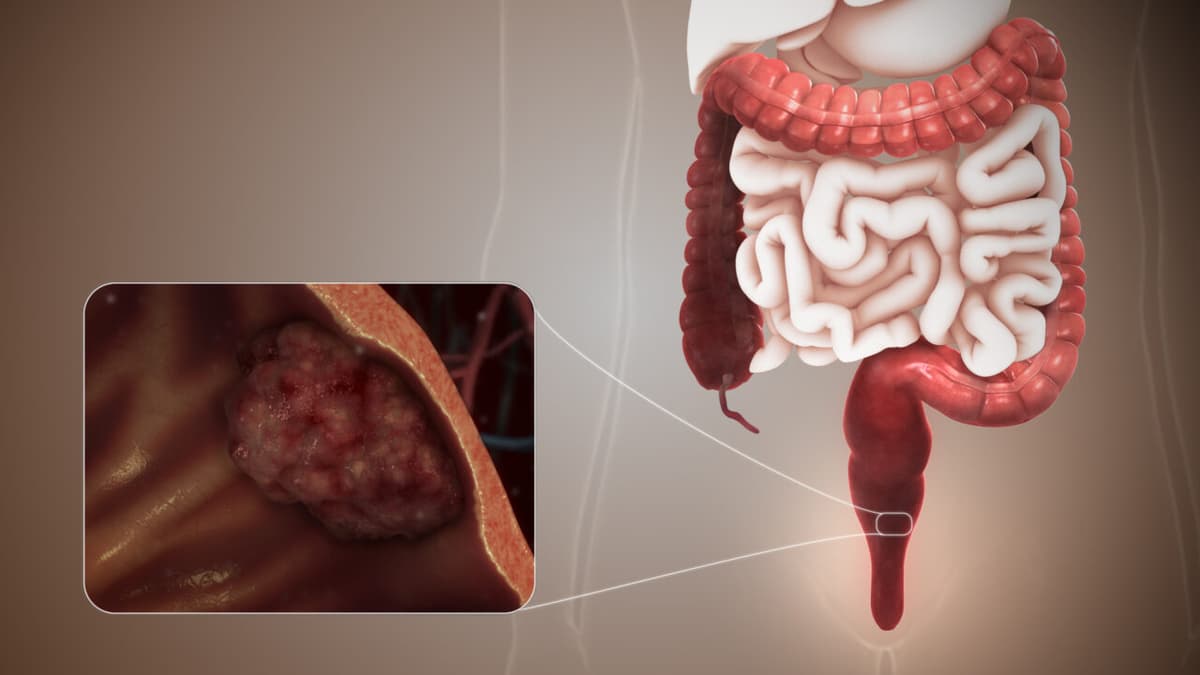 Các giai đoạn và phương pháp điều trị bệnh ung thư trực tràng