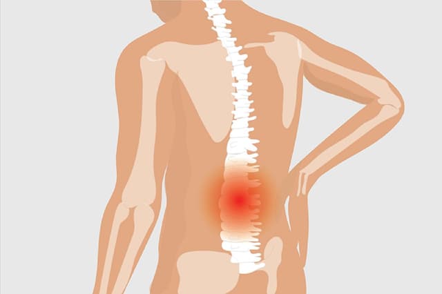 Cách điều trị viêm cột sống dính khớp là gì?