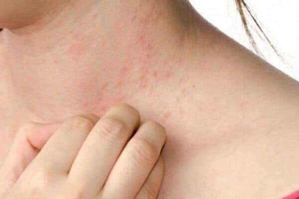 Hiện tượng sốt xuất huyết