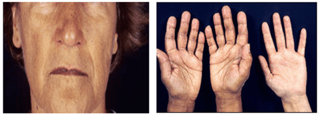 ACTH tăng gây bệnh Addison