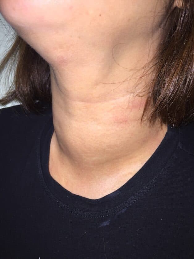 Ở giai đoạn 2 tuyến giáp tự miễn, bướu giáp bắt đầu sưng to lên