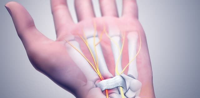 Tìm hiểu về hội chứng cổ tay: điều trị và phòng ngừa