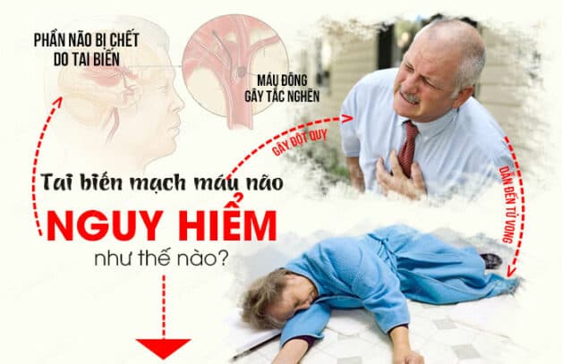 Ngừa tai biến đột quỵ để tránh biến chứng nguy hiểm