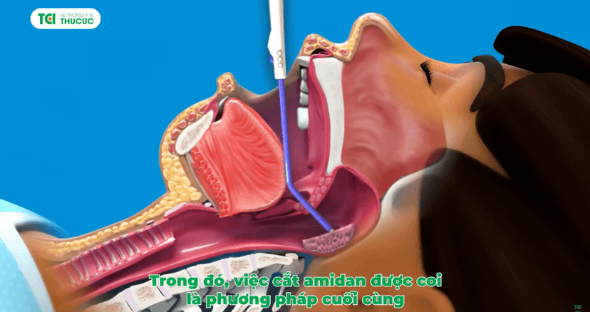 Có nên cắt amidan cho trẻ không?