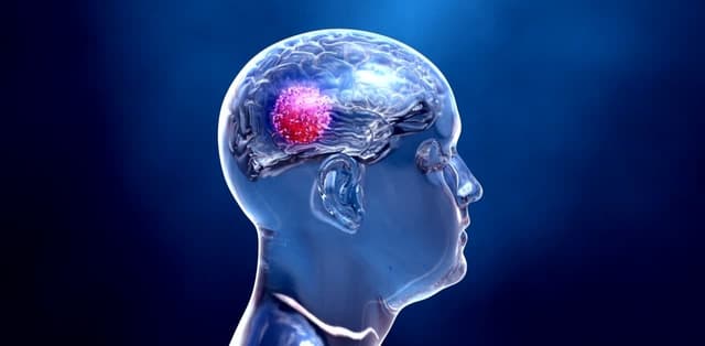 Dấu hiệu khối u tuyến yên cần lưu ý