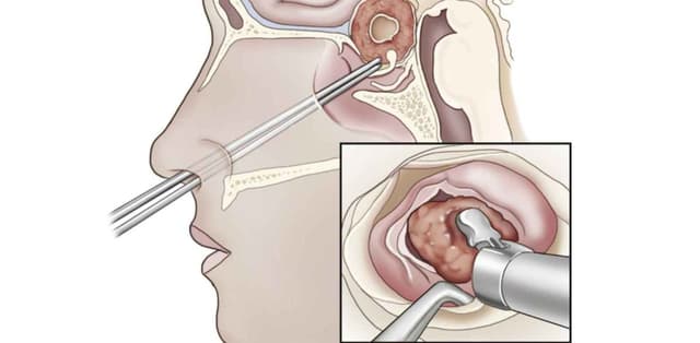 Phẫu thuật u tuyến yên: Mục tiêu, cách thực hiện