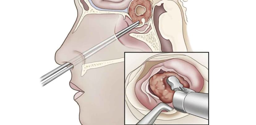 Phẫu thuật u tuyến yên: Mục tiêu, cách thực hiện