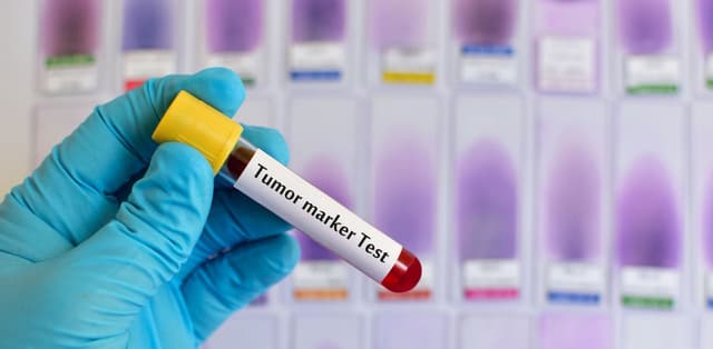 Xét nghiệm u tuyến thượng thận giúp chẩn đoán bệnh