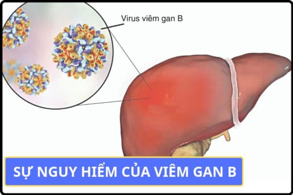 bệnh học xơ gan và nguyên nhân