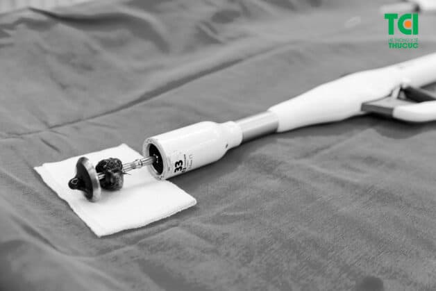 Súng Longo điều trị bệnh trĩ