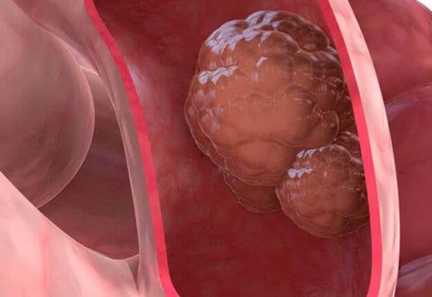 Bệnh trĩ có thể dẫn đến biến chứng ung thư trực tràng