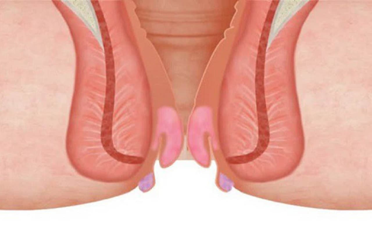 Bệnh trĩ có nên chạy bộ