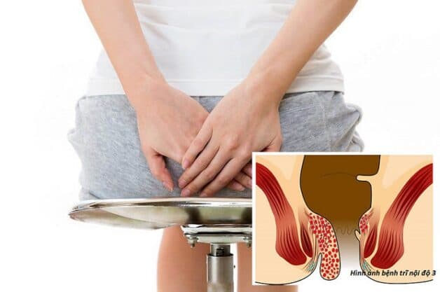 bệnh trĩ là bệnh gì