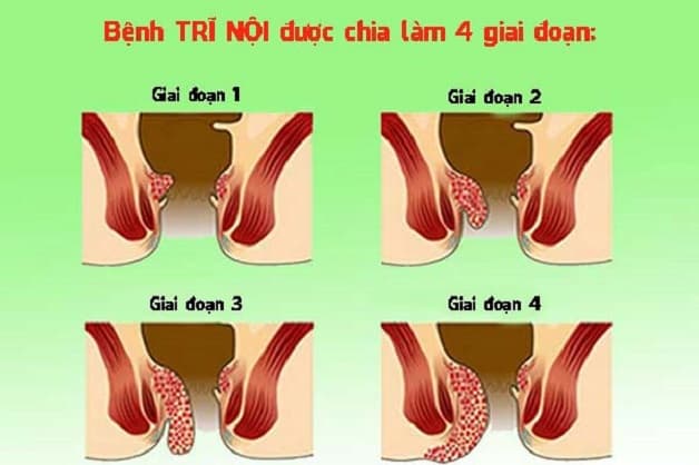 Các cấp độ của trĩ nội