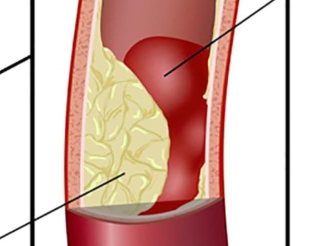 Bệnh xơ vữa động mạch vành