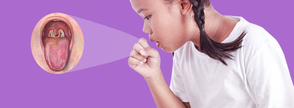 Bệnh bạch hầu ủ bệnh từ 2 - 5 ngày mới phát tác độc tố