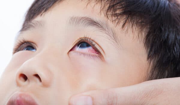 Làm sao để bạn nhận biết ra bệnh đỏ mắt