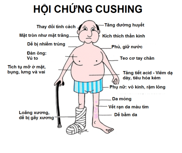 Cushing là một trong các dấu hiệu khối u tuyến yên