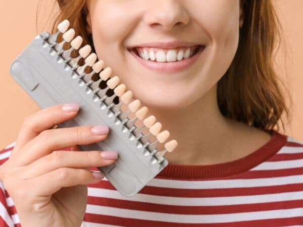 dán sứ veneer uy tín