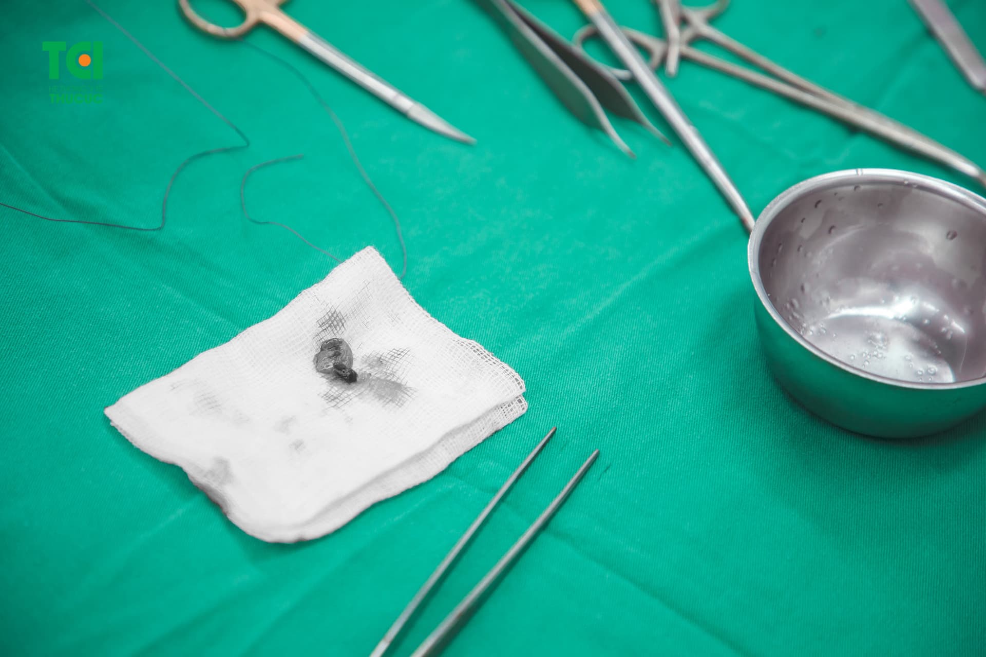 dấu hiệu bị bệnh trĩ