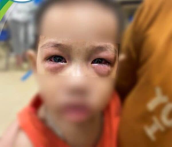 Đau mắt đỏ sưng húp là bị gì?