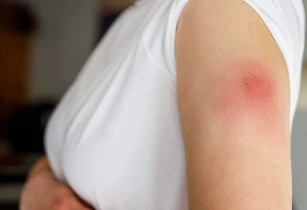 Sưng đỏ vết tiêm là một trong những dị ứng xảy ra khi tiêm phòng uốn ván