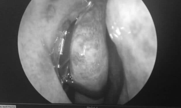 dị vật chui vào mũi