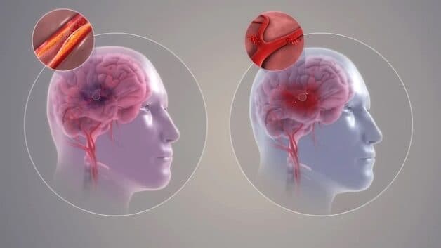 Thông tin về những người có nguy cơ đột quỵ cao