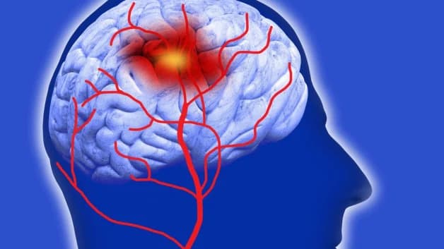 Ngăn chặn sớm nguy cơ đột quỵ