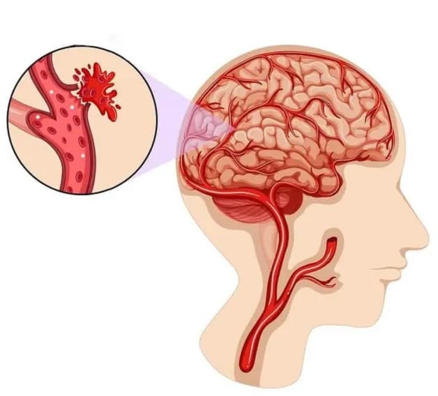 Nguy cơ đột quỵ xảy ra và cách kiểm soát