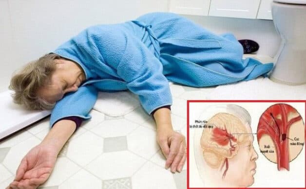 Đột quỵ là căn bệnh vô cùng nguy hiểm