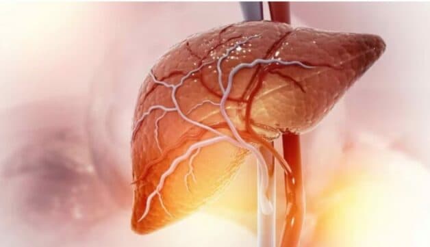 Mỡ tích tụ trong gan vượt quá 30% tổng trọng lượng gan được coi là gan nhiễm mỡ nặng 