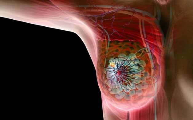 Giãn ống tuyến vú xuất hiện ở phụ nữ cho con bú lâu năm, người nhiều con.