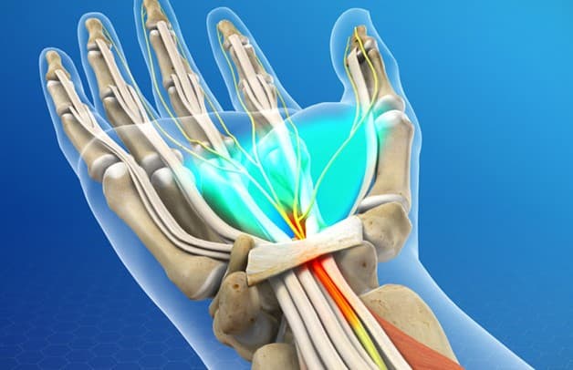 hội chứng cổ tay