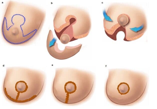 Phẫu thuật cắt bỏ mô vú là phương pháp phổ biến nhất