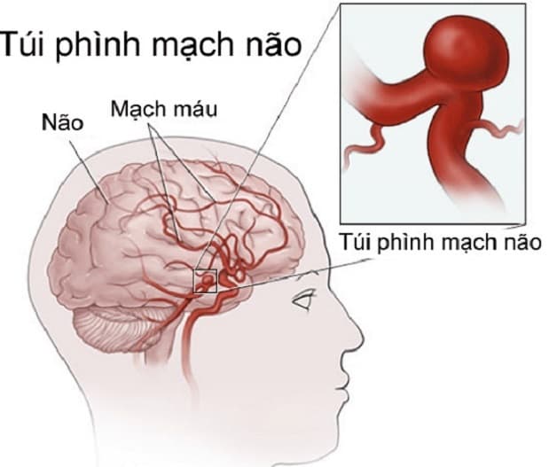 Bệnh học tai biến mạch máu não do dị dạng mạch máu não