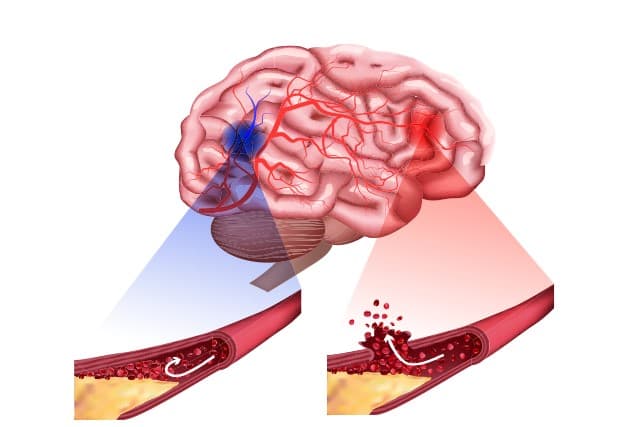 Các biện pháp tránh đột quỵ ghé thăm