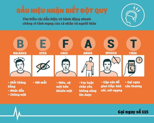 Quy tắc BE FAST giúp tránh các quan niệm sai lầm về đột quỵ.