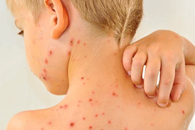 sốt xuất huyết ở trẻ nhỏ