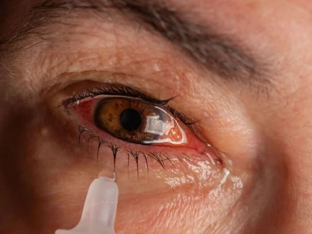 Một số sai lầm khi điều trị đau mắt đỏ