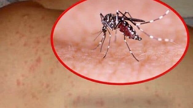 sốt xuất huyết và sốt virus