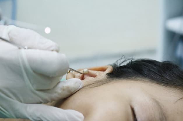 Trẻ nhét dị vật vào tai