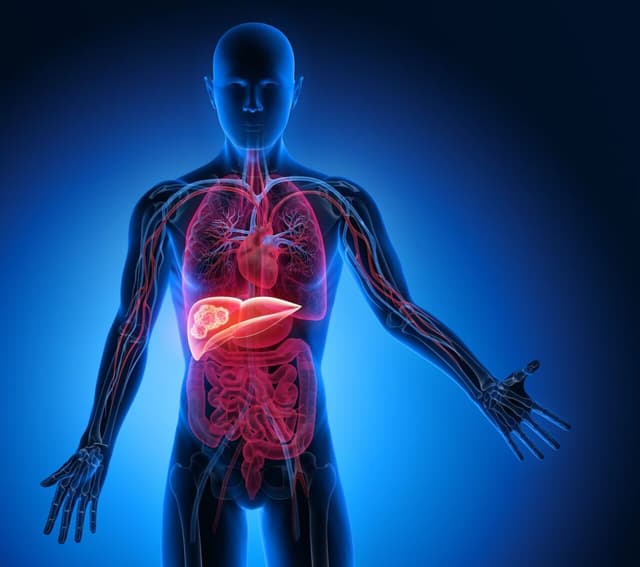 Diễn biến và cách chữa bệnh ung thư gan giai đoạn 3