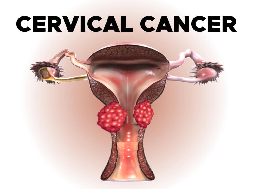 Ung thư cổ tử cung là một bệnh lý ác tính và ai cũng có nguy cơ mắc phải