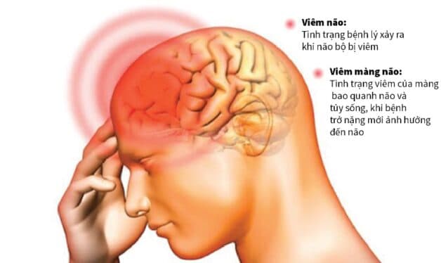 Viêm não là biến chứng sau khi mổ u tuyến yên