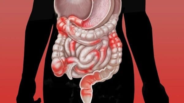 Bệnh Crohn cũng là một trong các nguyên nhân gây ra viêm ruột non