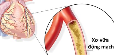Những nguyên nhân gây bệnh xơ vữa động mạch vành
