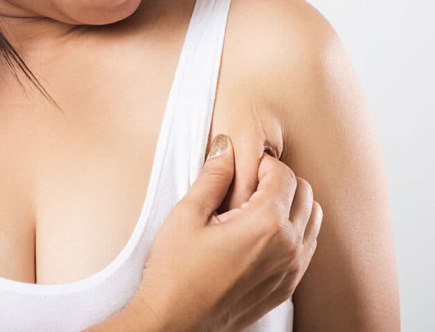 Tuyến vú lạc chỗ thường gây mất thẩm mỹ